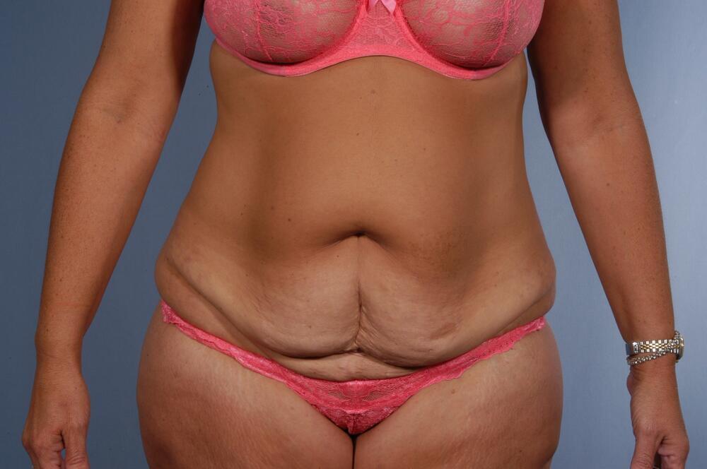 Tummy tuck Before & After Image