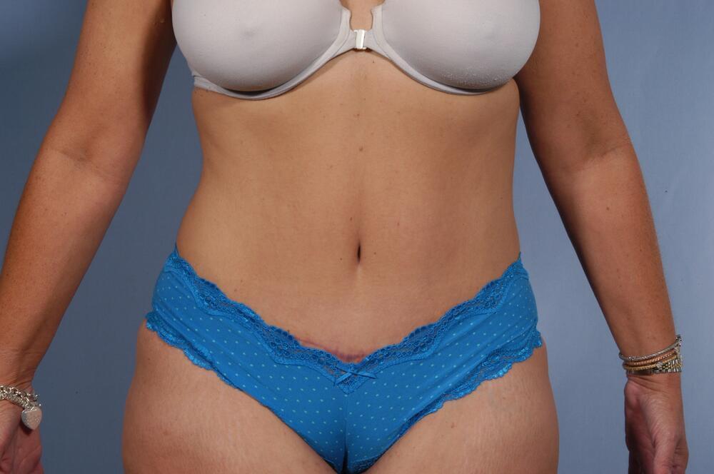 Tummy tuck Before & After Image