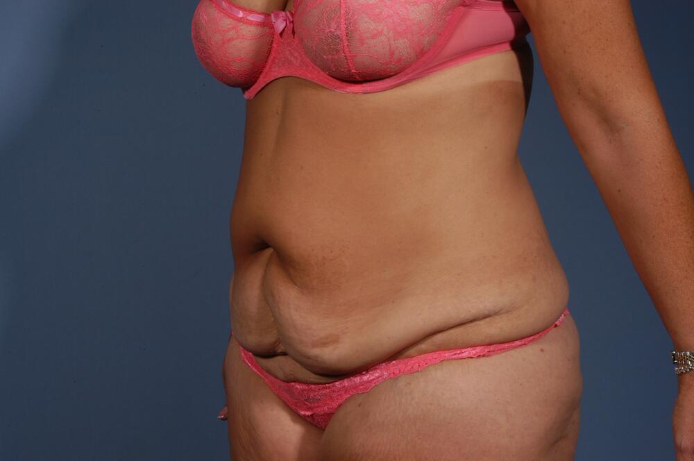 Tummy tuck Before & After Image