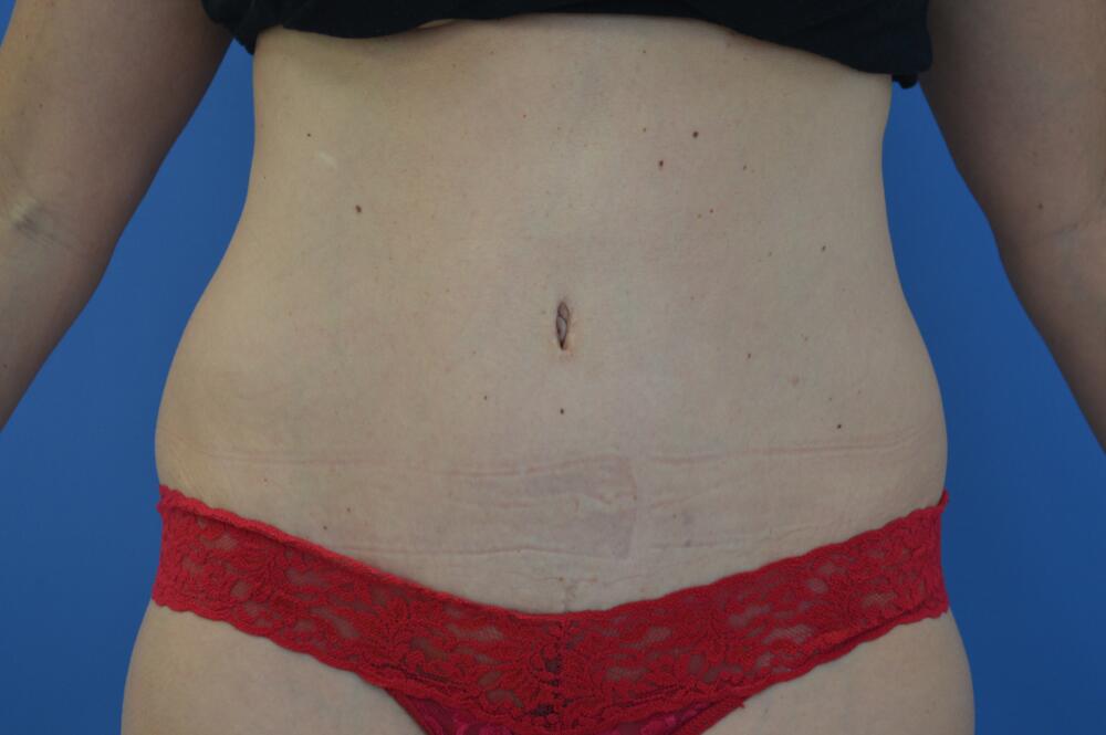 Tummy tuck Before & After Image