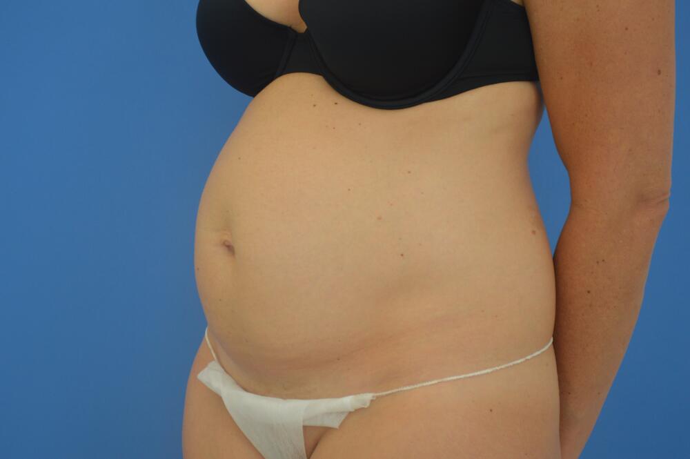 Tummy tuck Before & After Image