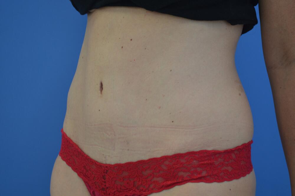 Tummy tuck Before & After Image