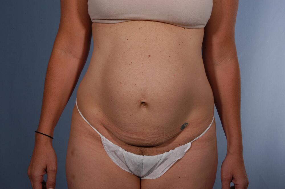Tummy tuck Before & After Image