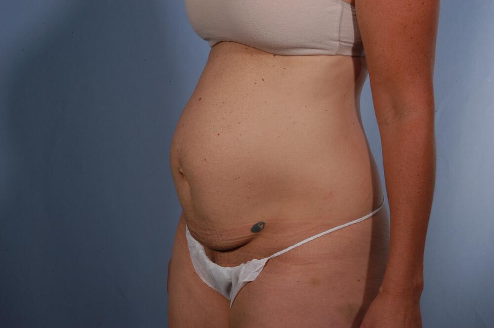 Tummy tuck Before & After Image