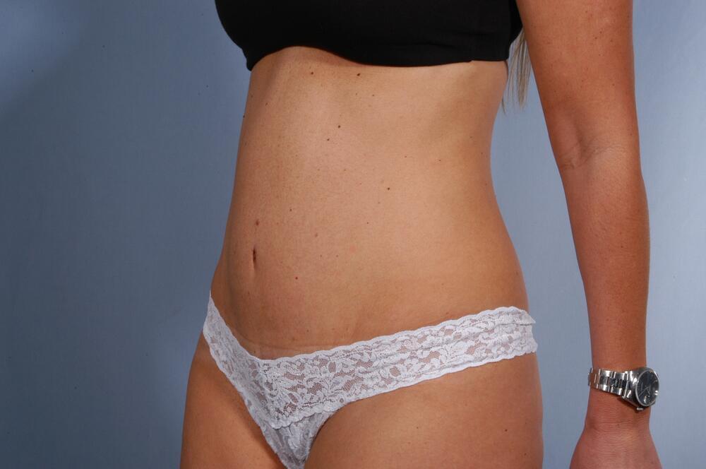 Tummy tuck Before & After Image