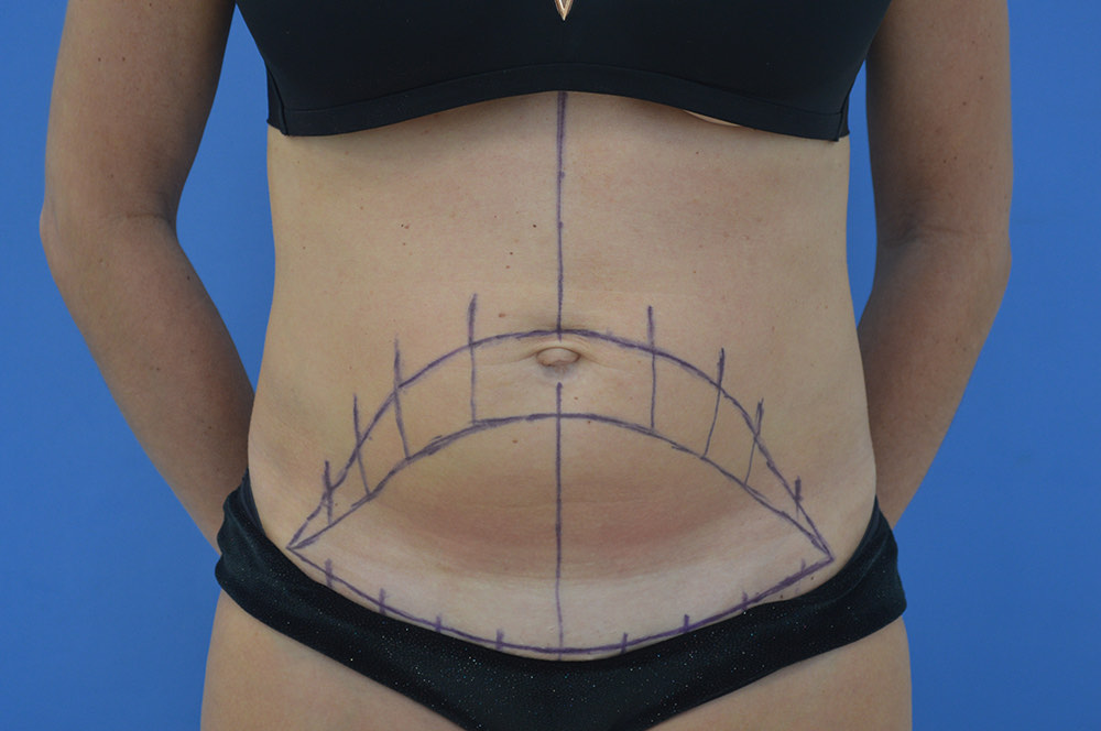 Tummy tuck Before & After Image