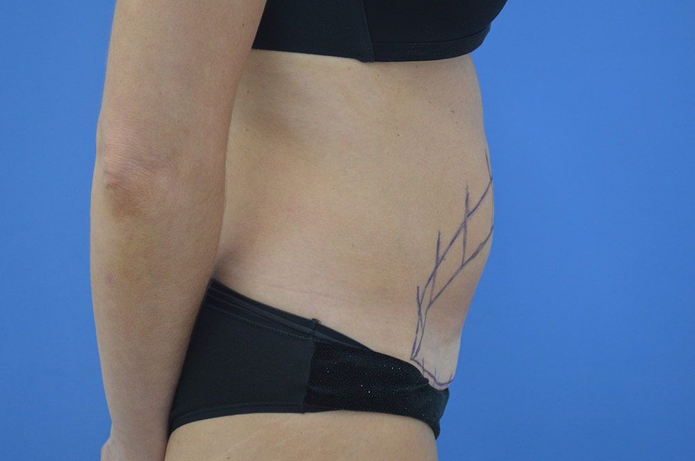 Tummy tuck Before & After Image