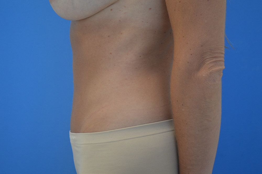 Tummy tuck Before & After Image