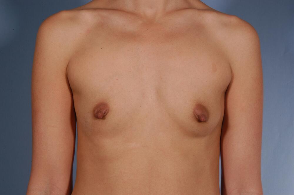 Breast augmentation Before & After Image