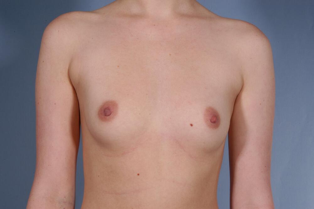 Breast augmentation Before & After Image