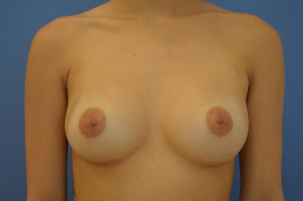 Breast augmentation Before & After Image