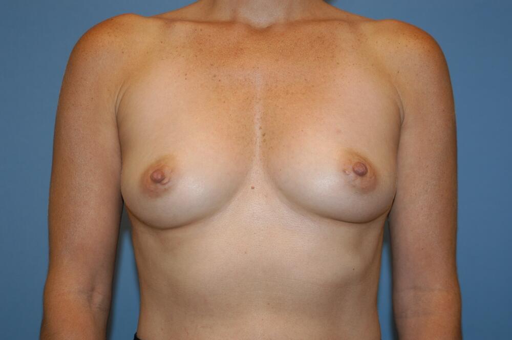 Breast augmentation Before & After Image