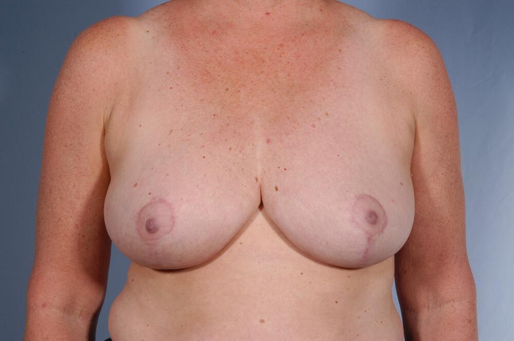 Breast reduction Before & After Image