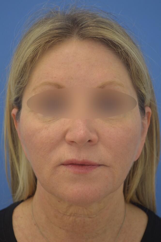 Face and neck lift Before & After Image