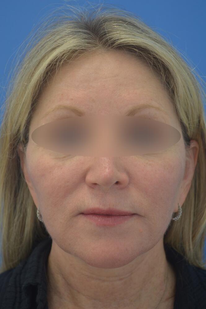 Face and neck lift Before & After Image