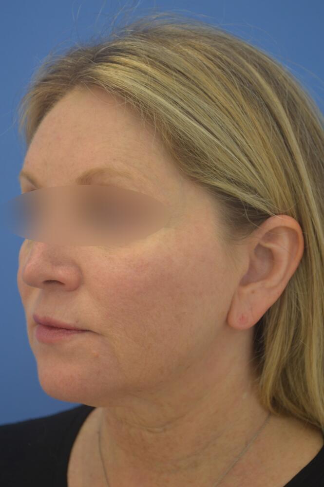 Face and neck lift Before & After Image