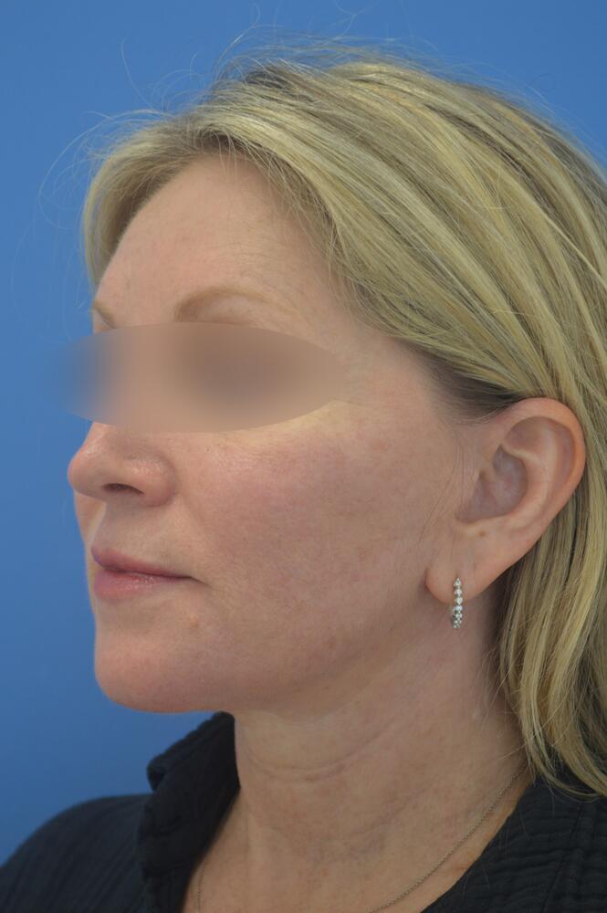 Face and neck lift Before & After Image