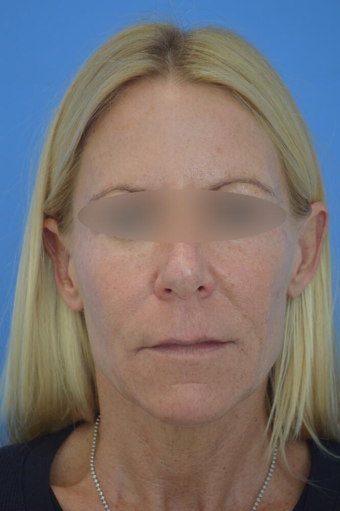 Face and neck lift Before & After Image