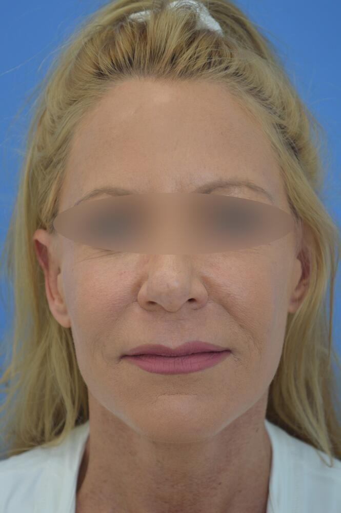 Face and neck lift Before & After Image