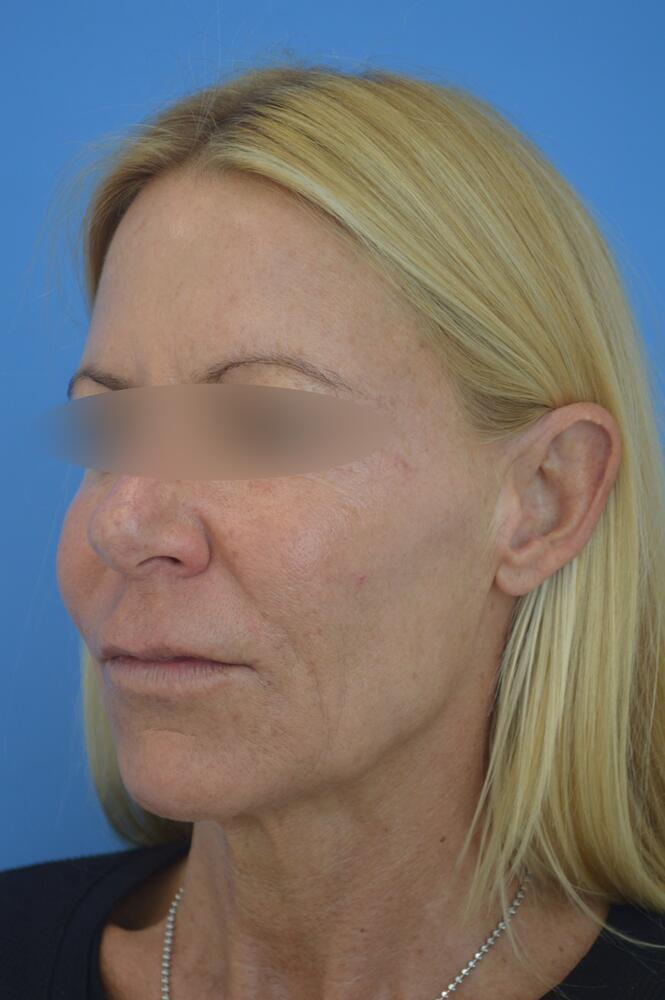 Face and neck lift Before & After Image