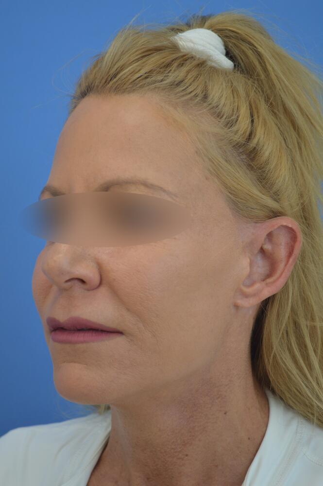 Face and neck lift Before & After Image
