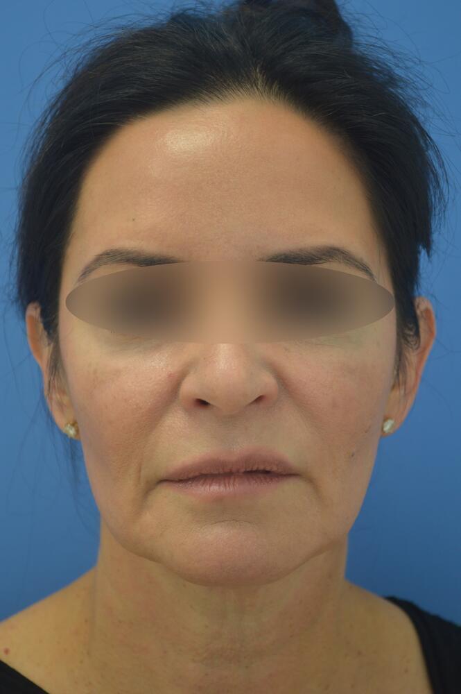 Face and neck lift Before & After Image
