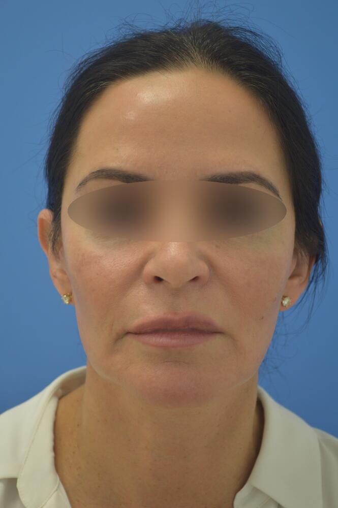 Face and neck lift Before & After Image