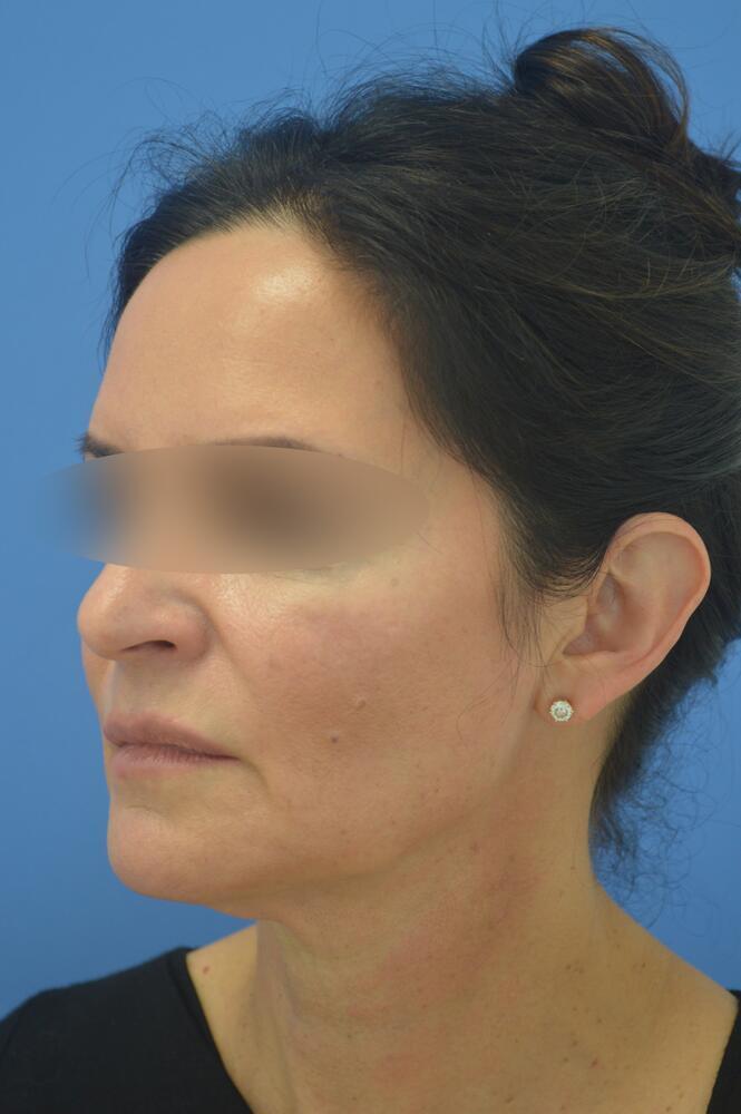 Face and neck lift Before & After Image