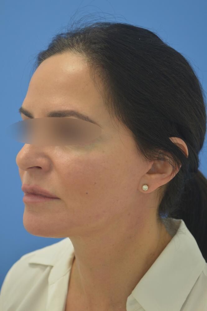 Face and neck lift Before & After Image