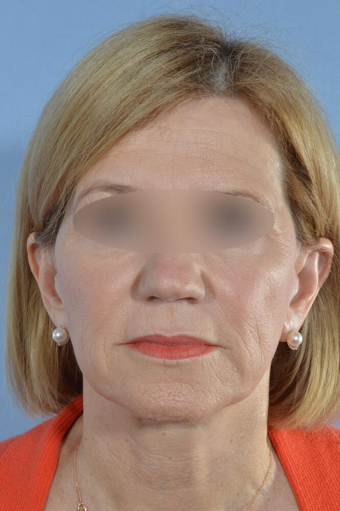 Face and neck lift Before & After Image