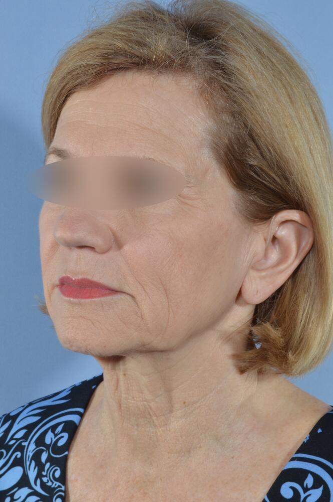 Face and neck lift Before & After Image