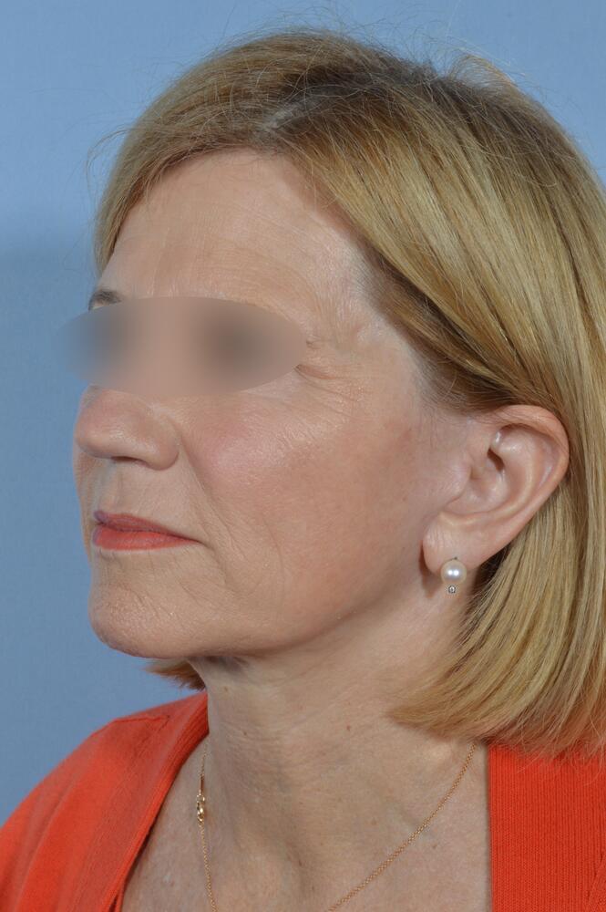 Face and neck lift Before & After Image