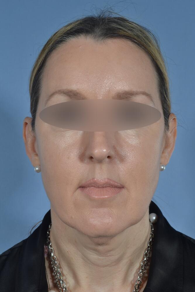 Face and neck lift Before & After Image