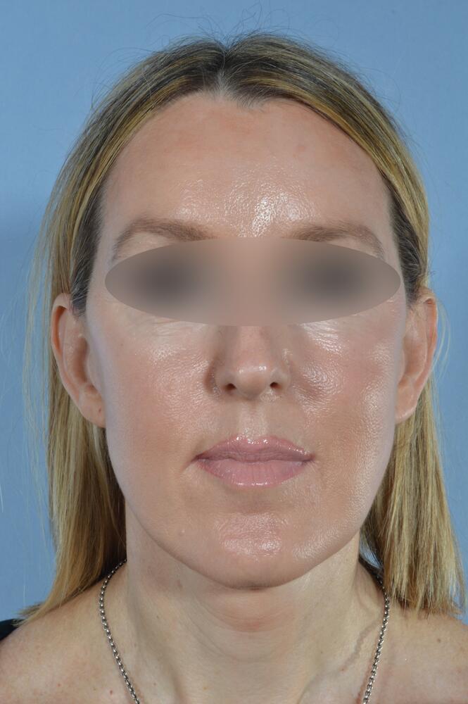 Face and neck lift Before & After Image