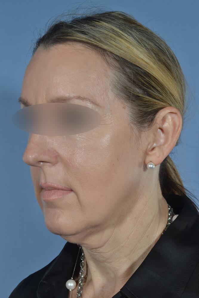 Face and neck lift Before & After Image