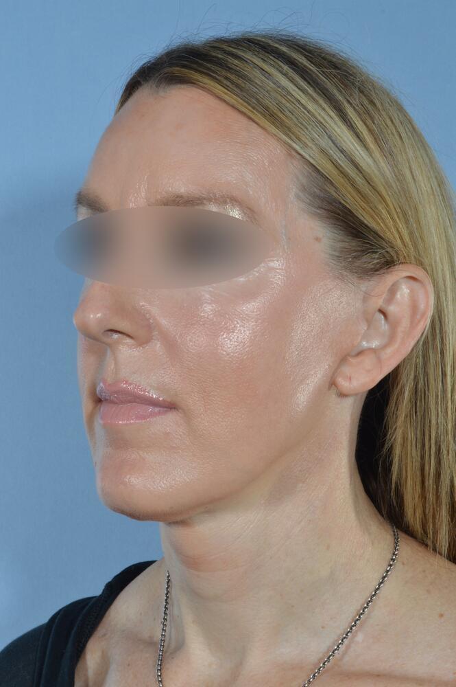 Face and neck lift Before & After Image