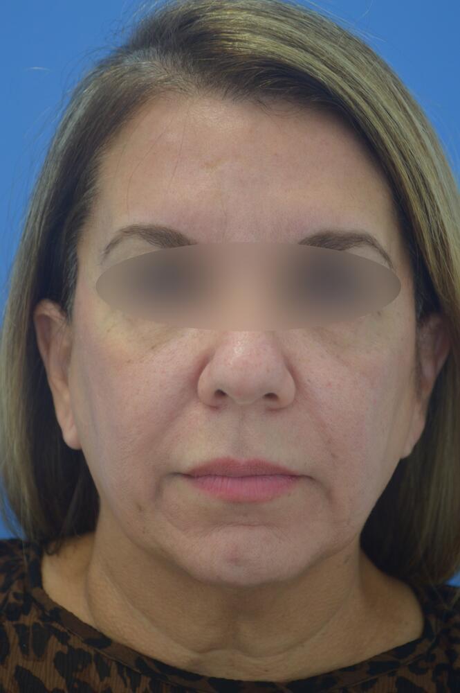 Face and neck lift Before & After Image