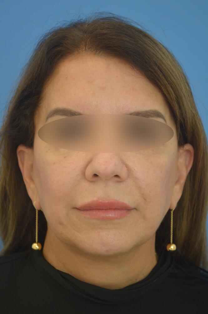 Face and neck lift Before & After Image