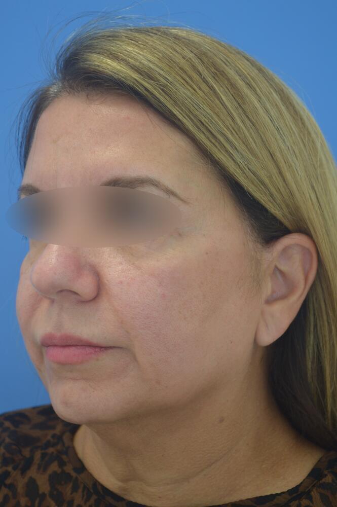Face and neck lift Before & After Image
