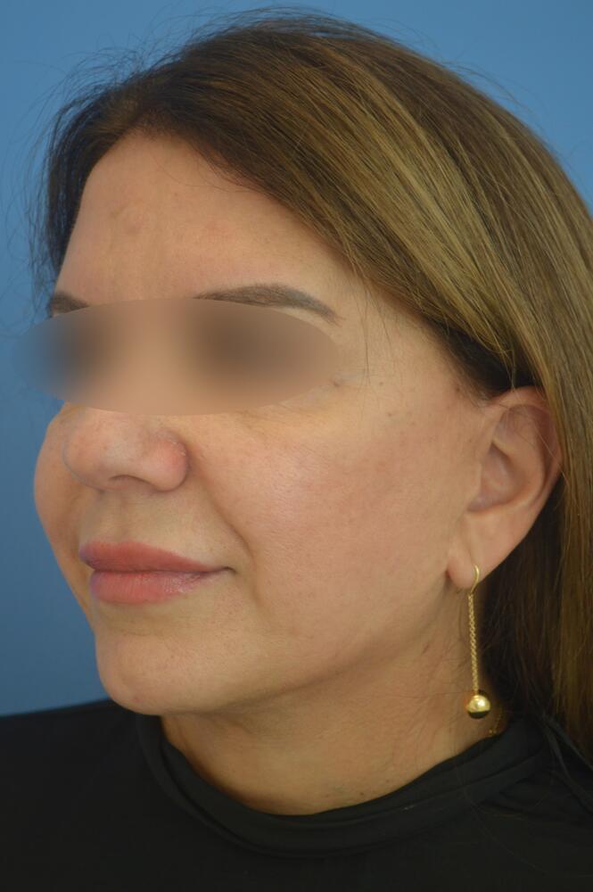 Face and neck lift Before & After Image