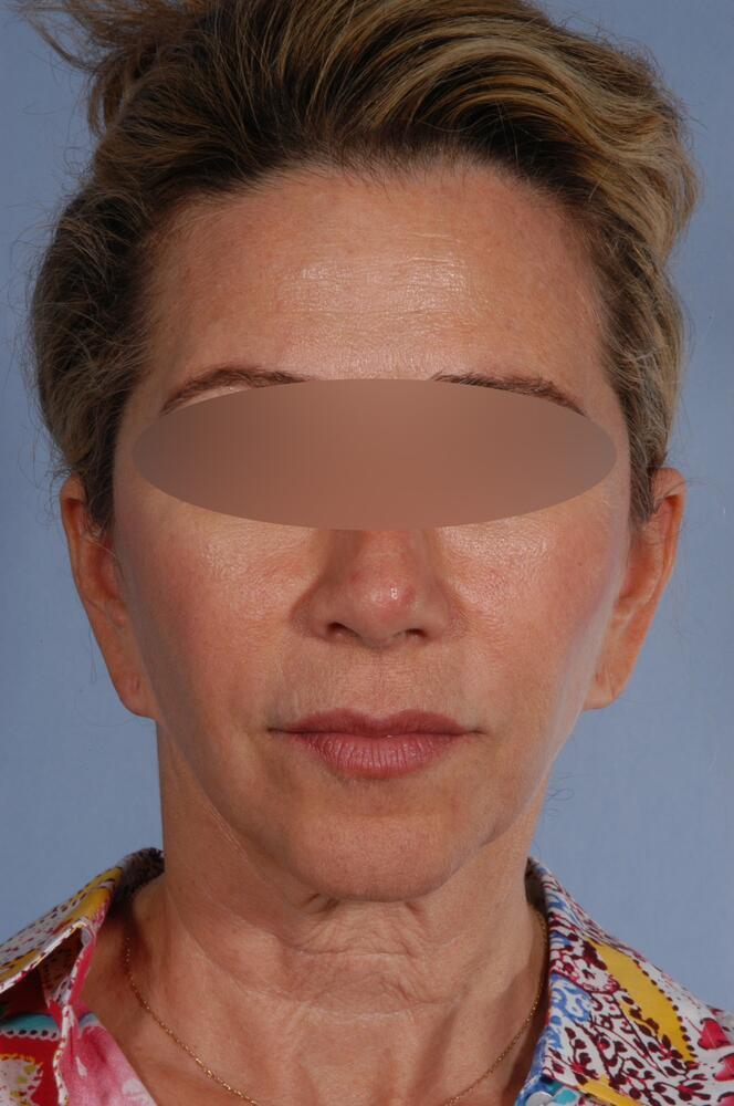 Face and neck lift Before & After Image