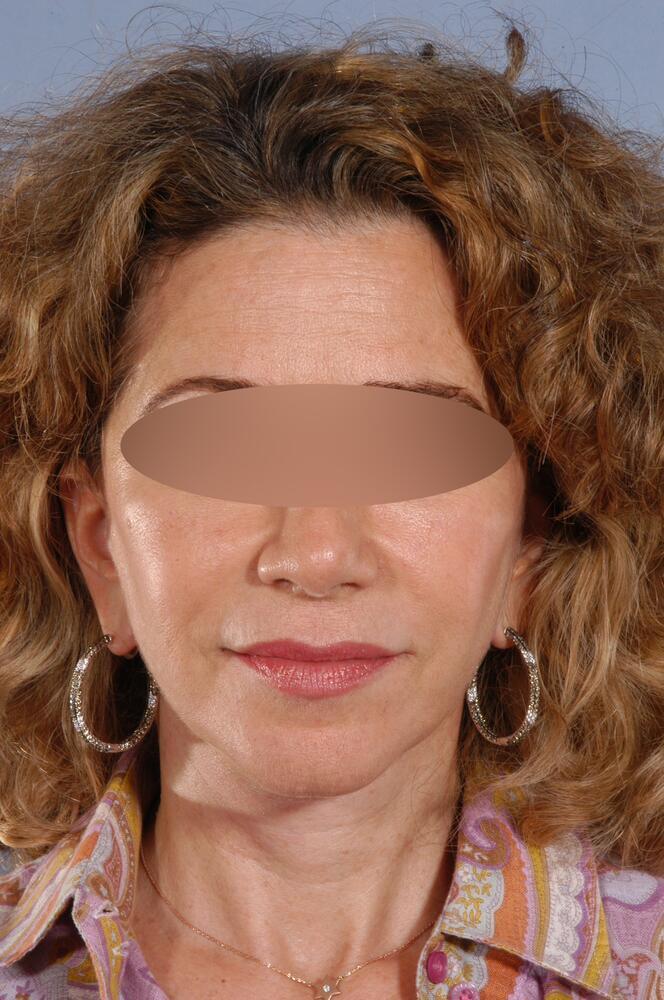 Face and neck lift Before & After Image