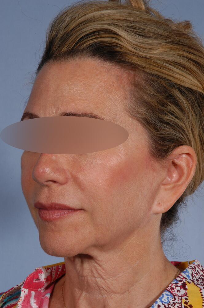 Face and neck lift Before & After Image