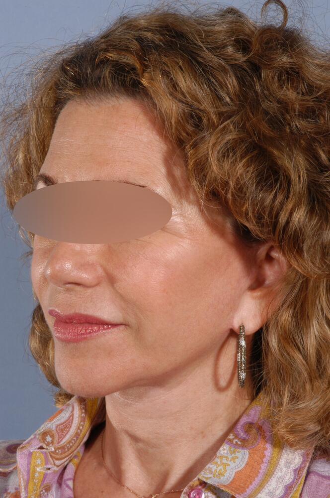 Face and neck lift Before & After Image