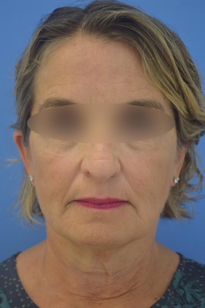 Face and neck lift Before & After Image
