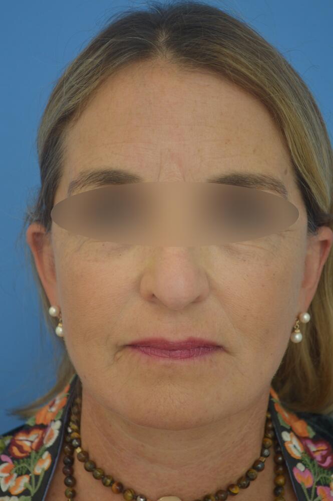 Face and neck lift Before & After Image