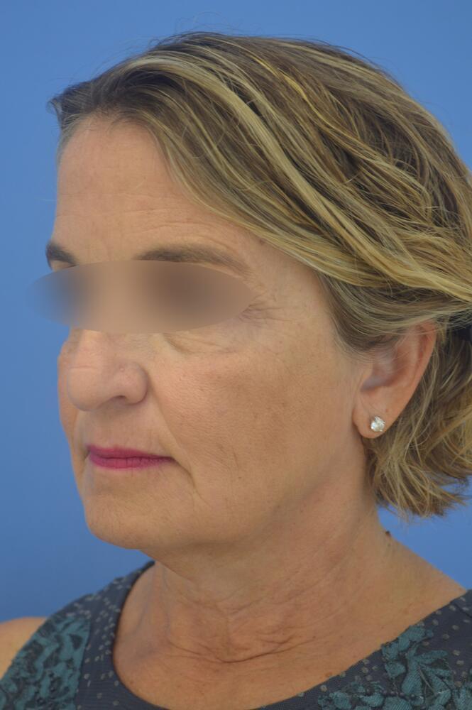 Face and neck lift Before & After Image