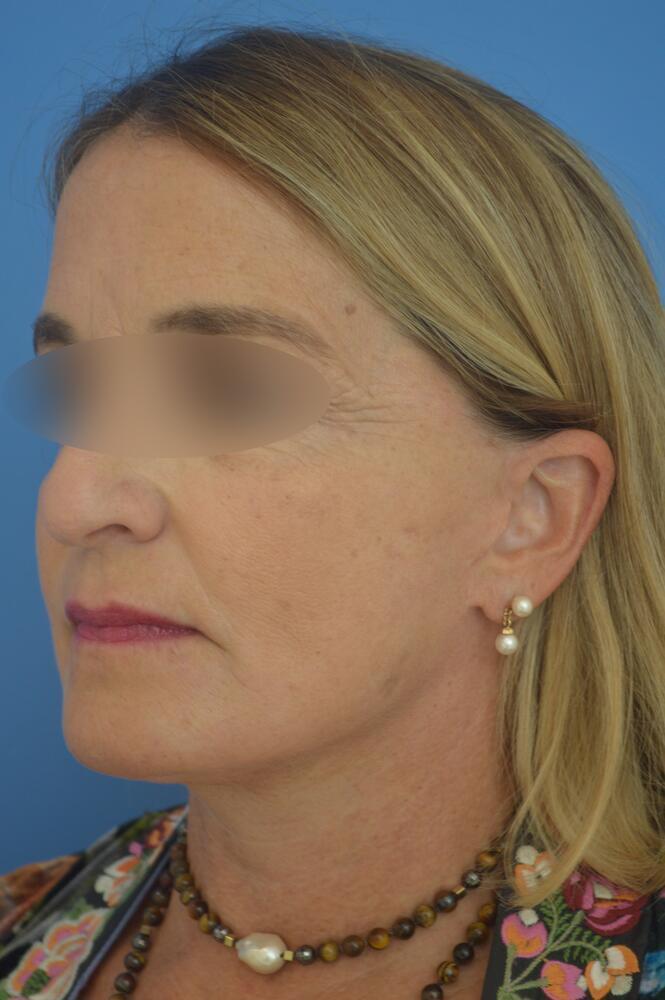 Face and neck lift Before & After Image