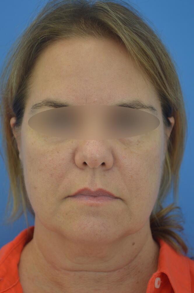 Face and neck lift Before & After Image