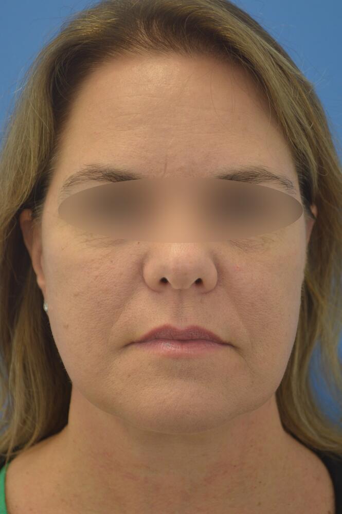Face and neck lift Before & After Image